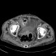 Diffuse peritonitis, dehiscence of rectal anastomosis: CT - Computed tomography